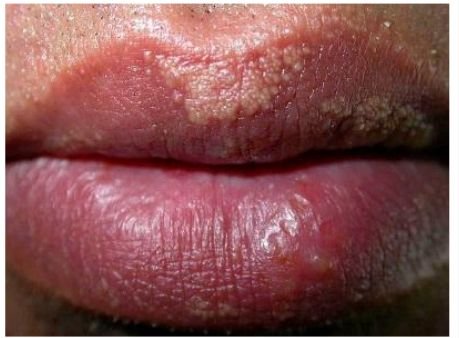 Grains de Fordyce sur les lèvres : Symptômes, causes, traitements