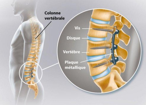 Comprendre la Laminectomie : Informations Complètes sur la Chirurgie
