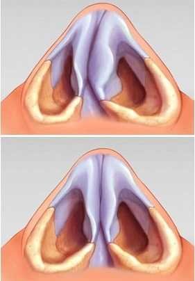 Comprendre la Septoplastie : Tout ce que Vous Devez Savoir
