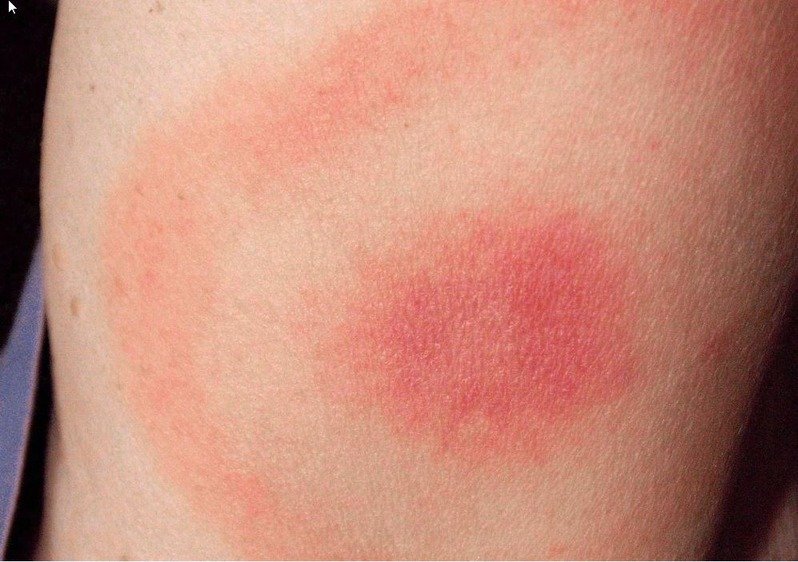 Comprendre la Maladie de Lyme