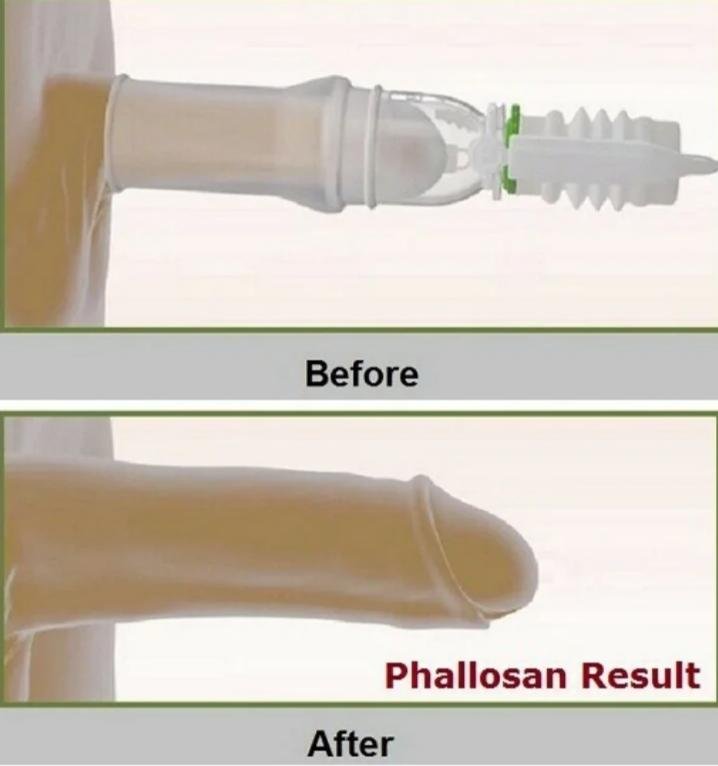 phallosan forte Résultats avant après