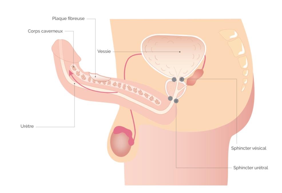 Pénis tordu : Causes, traitements et solutions