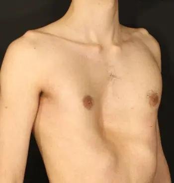 Pectus Excavatum