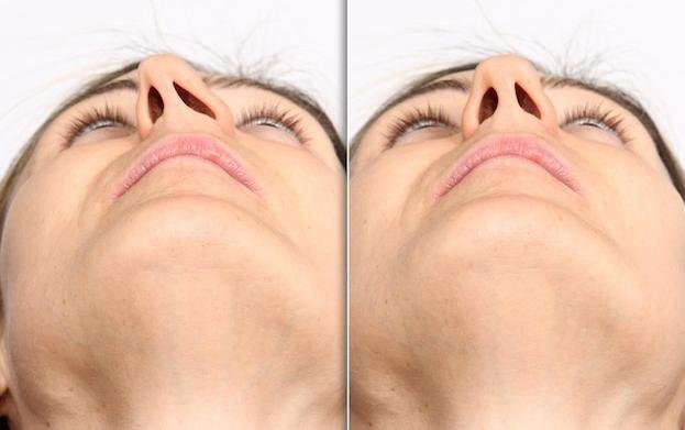 Septoplastie chirurgie