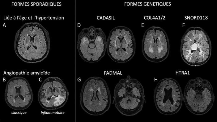 Leucopathie vasculaire Fazekas 1