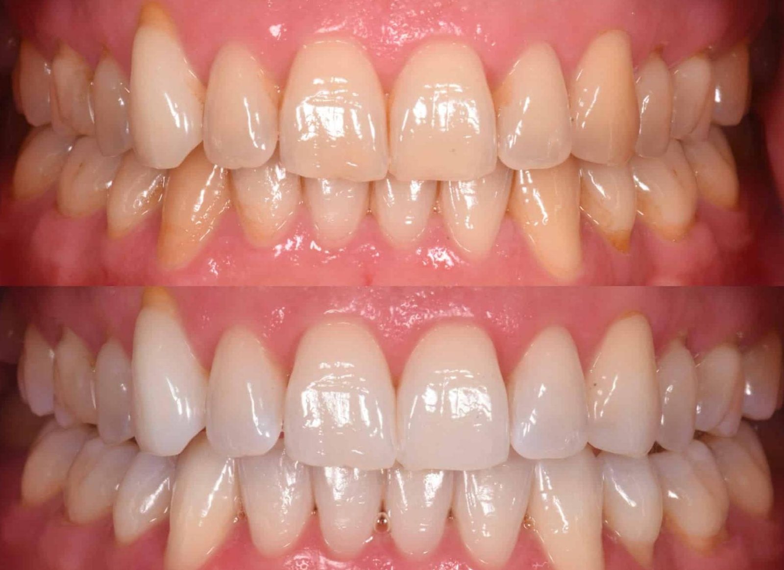 blanchiment dentaire