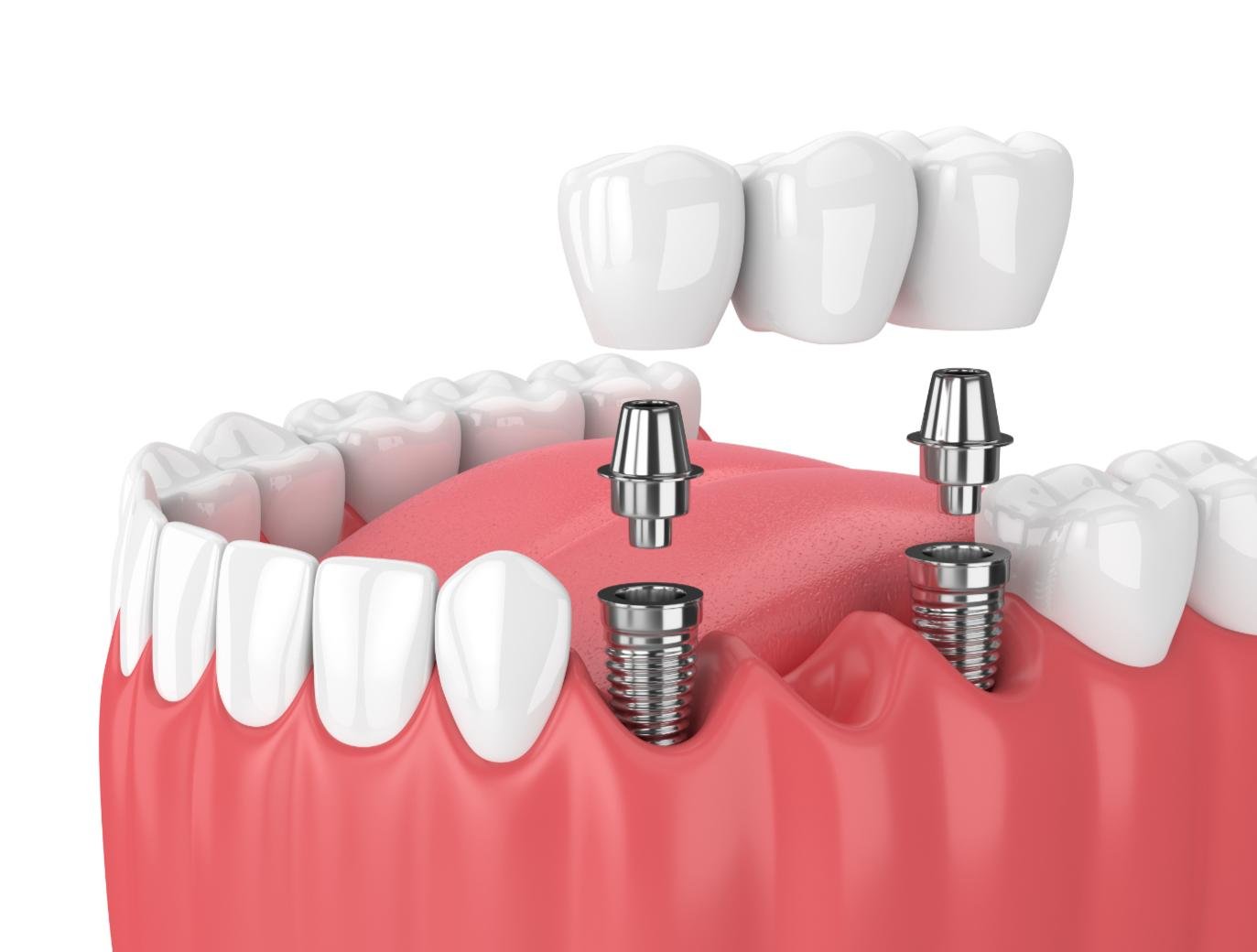 implant dentaire