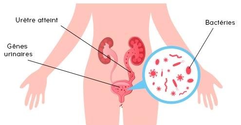 infection urinaire sans traitement  