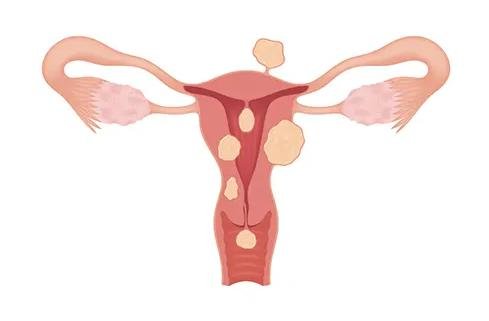 myomectomie